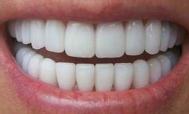 Имплантация зубов: противопоказания